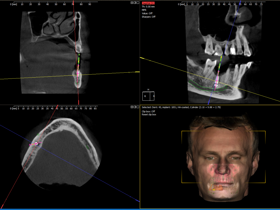 CBCT scan